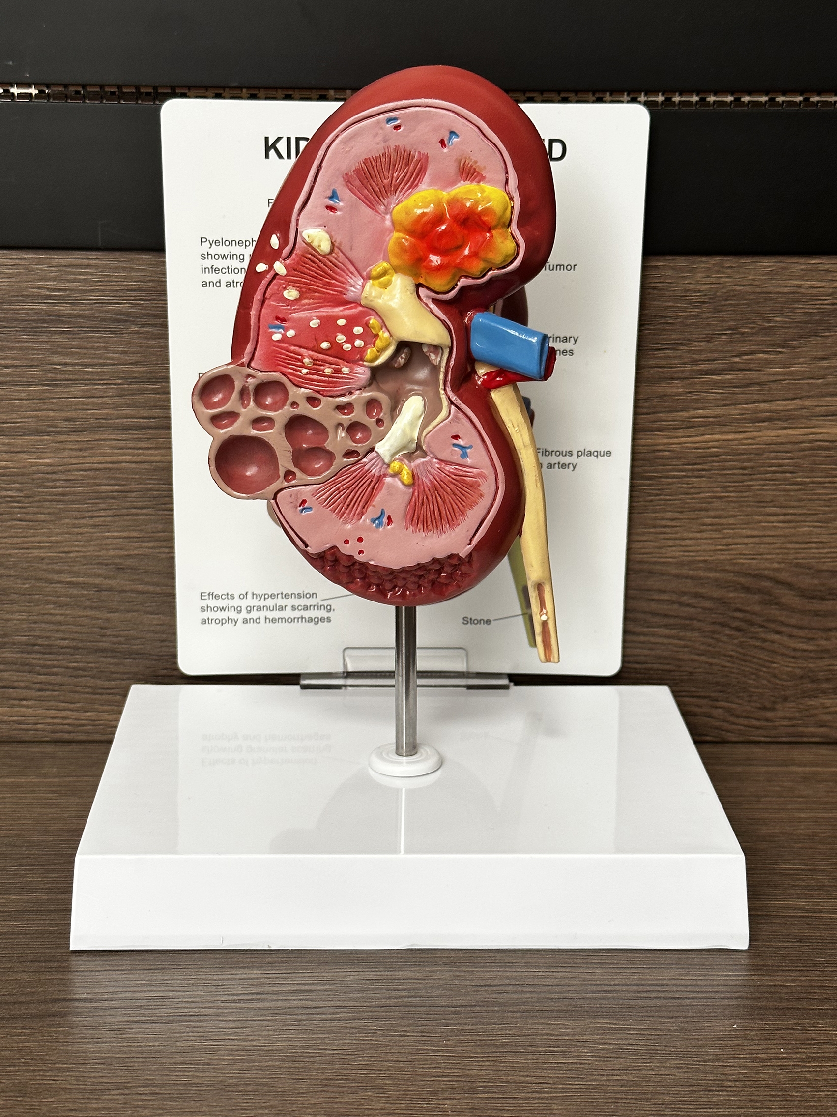 肾脏结构解剖模型 病变内脏器官泌尿科肾小球肾单位教学展示教具