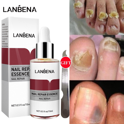 Nail Repair Essence Fungus Removal Gel Anti Infection Parony