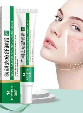 Herbal Acne Treatment Cream Face Scar Blackhead Remover Repa
