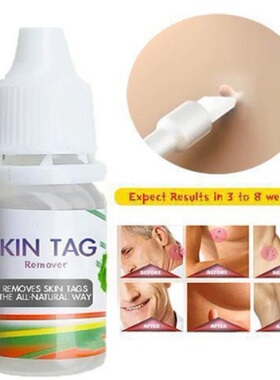 10ml Skin Tag Remover Wart Treatment Papillomas Removal Liqu