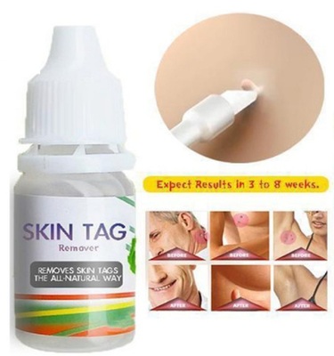 10ml Skin Tag Remover Wart Treatment Papillomas Removal Liqu