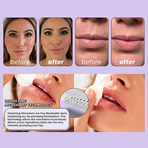 1 Pair Hyaluronic Acid Microneedle Lip Patches For Anti Wrin