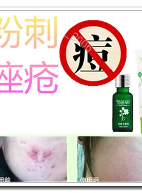 去闭口粉刺黑头护肤品套装痤疮黑头面膜祛除男女青春痘痘印霜正品