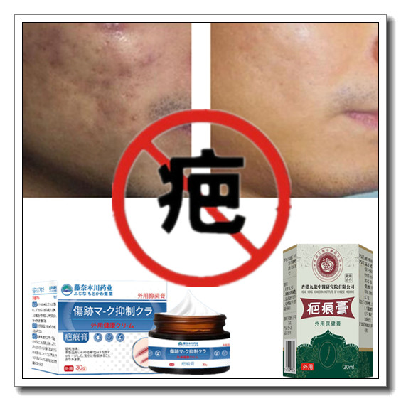 祛疙瘩修复增生性凹凸去除手术缝针烧伤烟烫疤痕印色素正品软膏液