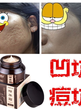 祛除抚平凹陷痘疤痕再生长修护膏消印抚痕霜填平凹洞痘坑痘印产品