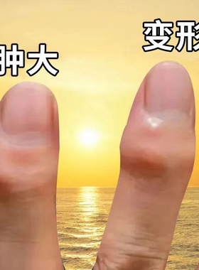 类风湿性手指肿大粗大增生酸麻僵硬