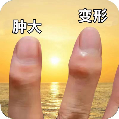 类风湿性手指肿大粗大增生疼痛酸麻僵硬