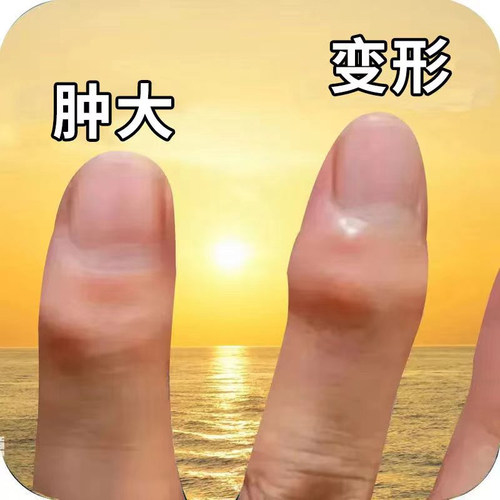 类性手指肿大粗大增生酸麻僵硬