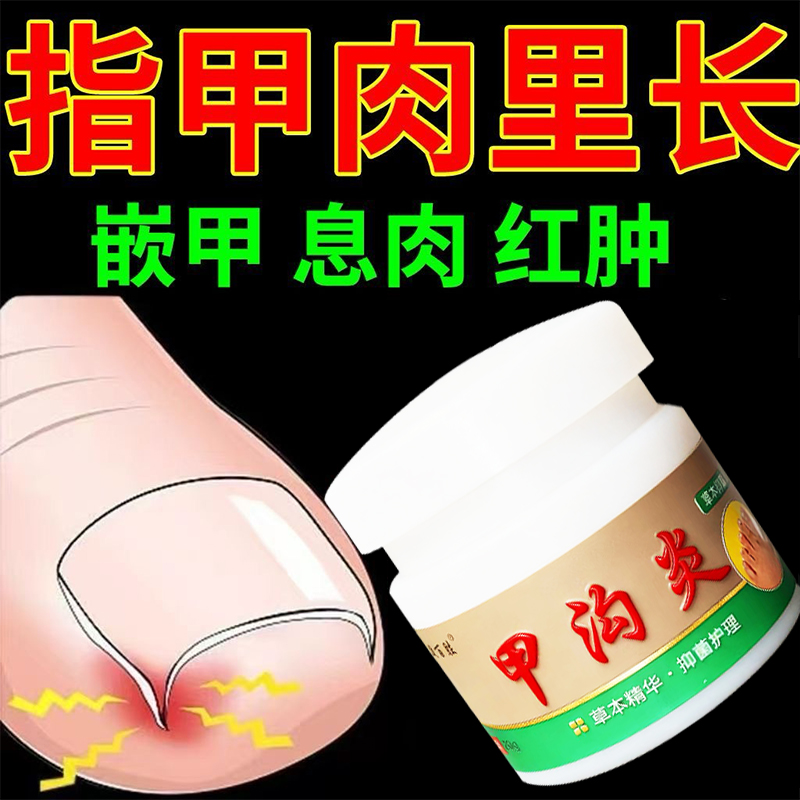大拇指往肉里长脚趾缝脚指甲疼销肿感染发红肿化脓脚指甲止痛膏