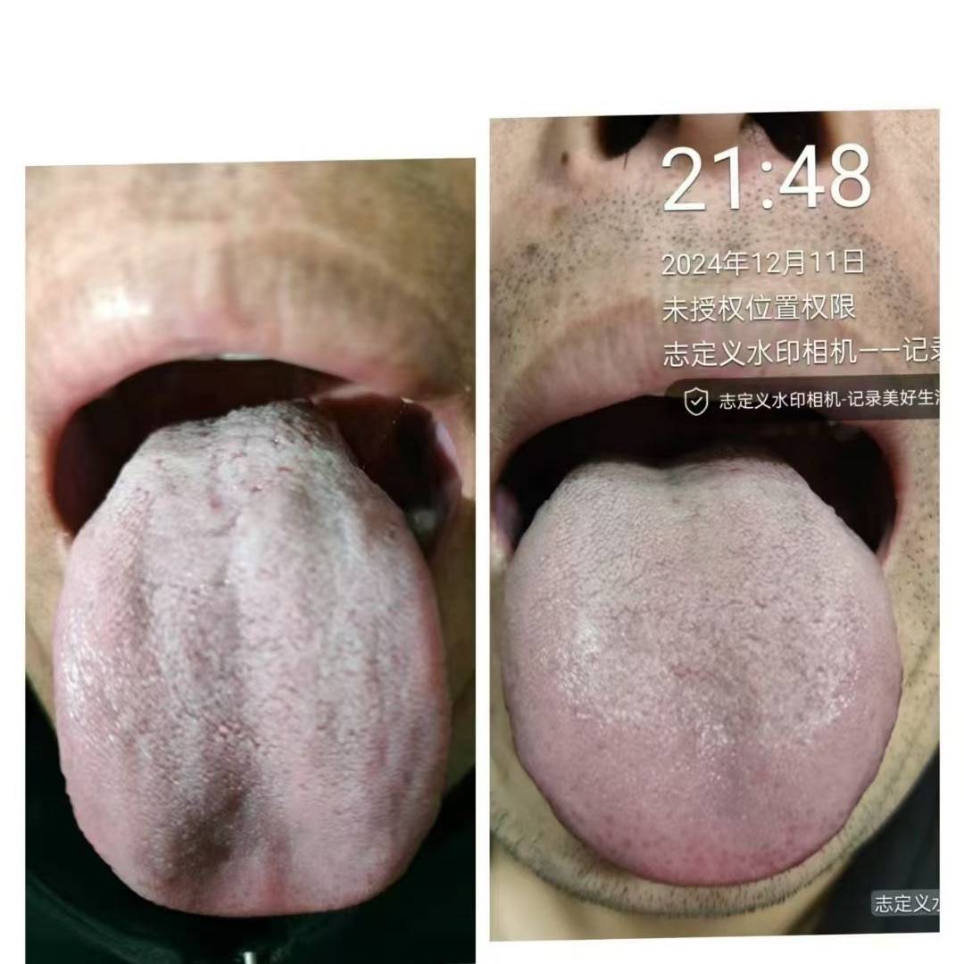 议价秀梅老公的脚气，21天的效果咋样[强适用