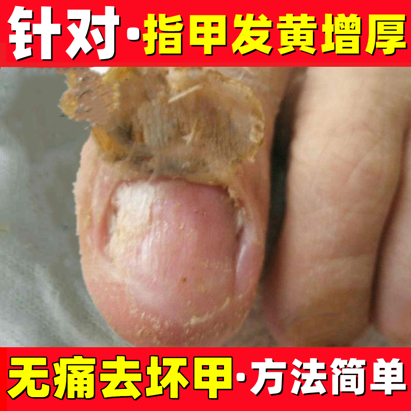 灰指甲药水特效专用凤仙花抑菌液亮甲真菌感染脱甲膏修甲刀剪正品