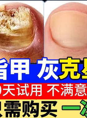 灰指甲药水特效专用凤仙花抑菌液软甲日本脱甲膏修甲刀正品EE