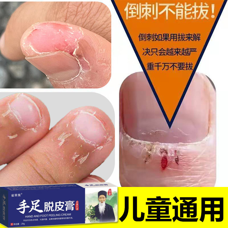 手上长肉刺防倒刺手足脱皮膏去手指倒刺修复儿童指甲边缘干裂专用