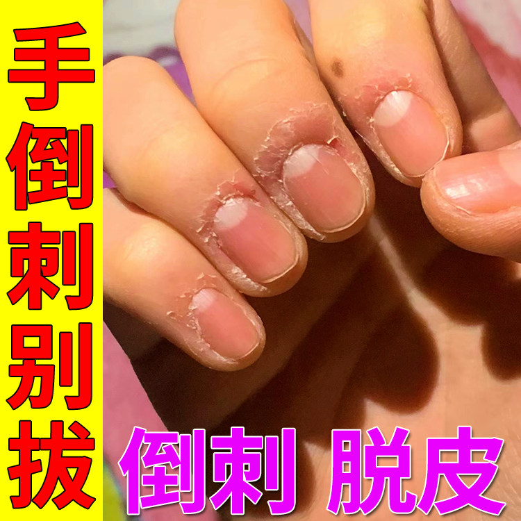 手指倒刺修复指甲边缘干裂脱皮去手上长肉刺防倒刺手足脱皮修护膏