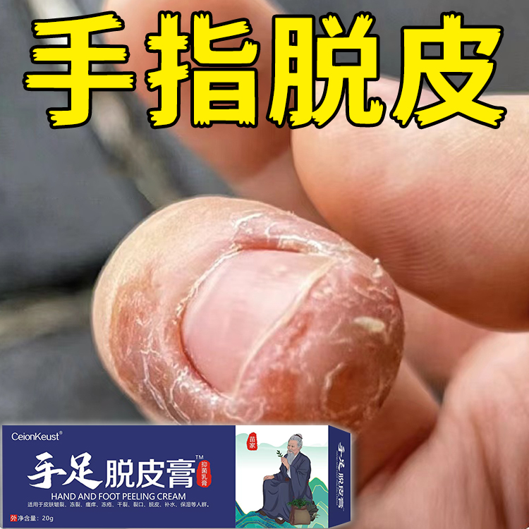 手足脱皮膏手指起皮指甲边缘干裂脱屑儿童手上长肉刺防倒刺修护霜