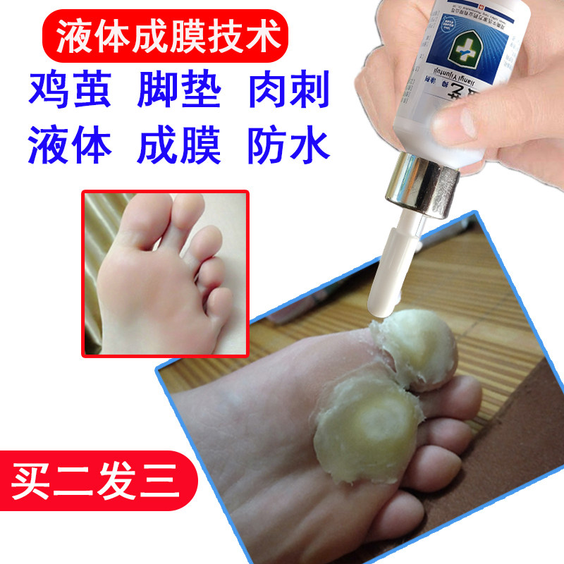 脚疔老茧去除脚底鸡茧脚垫肉刺神器软化角质死皮足部鸡茧