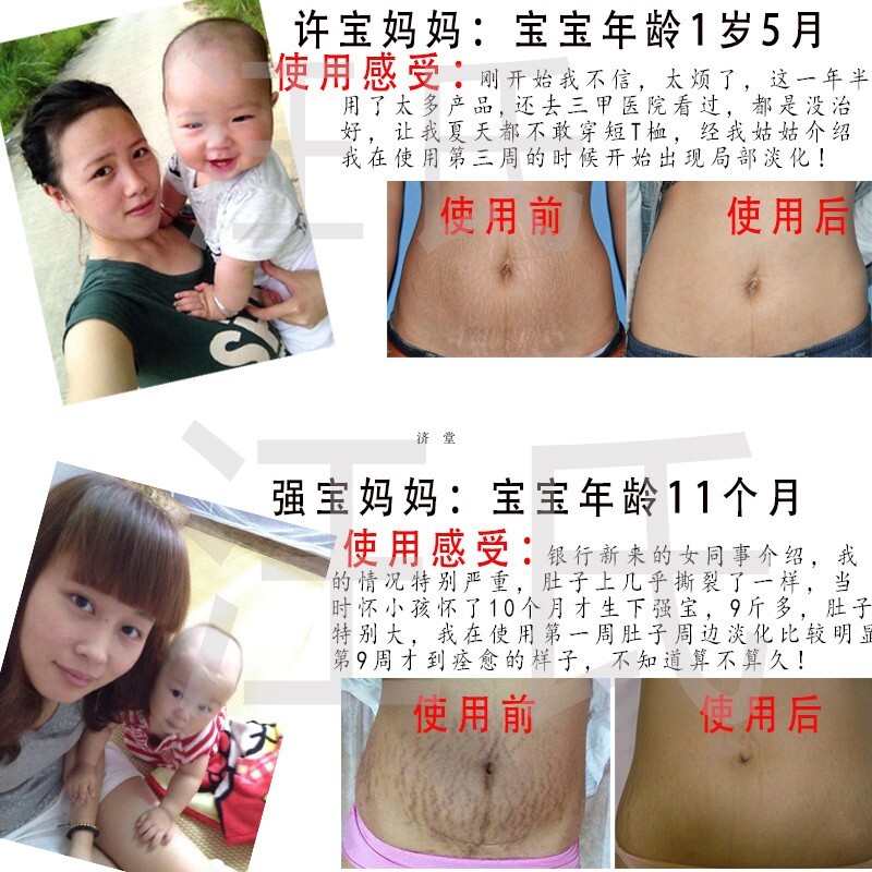 [巴宝菲旗舰店妊娠纹护理]汪氏祛去妊娠纹产后修复霜去肥胖纹大腿月销量0件仅售310.2元