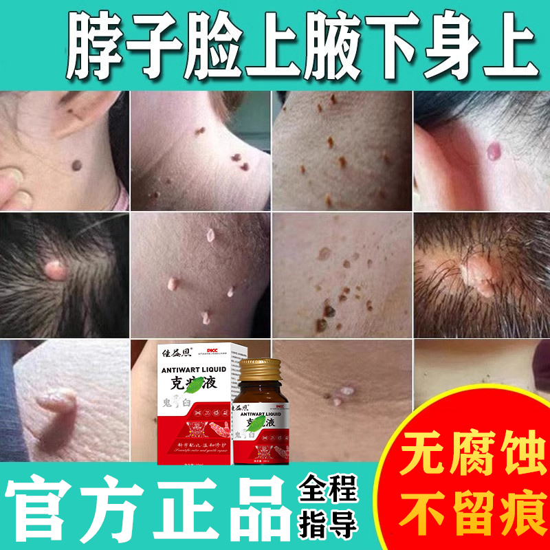 男女性生殖器假性尖锐湿疣去疣鬼臼毒素软膏检测自检LLhpv