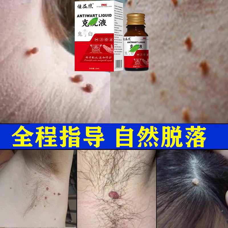 鬼臼毒素酊剂毒素酊药王井正品男女私处生殖器尖锐湿溶液小肉粒尤