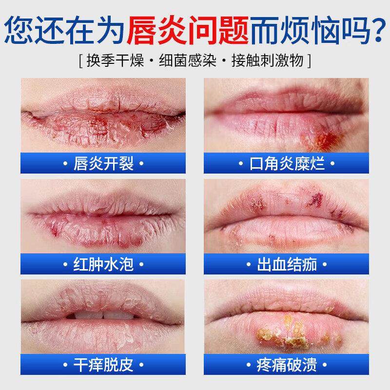 嘴皮润唇干裂脱滋润唇膏唇炎疱疹药膏起皮上SRE火嘴角出血溃烂专,美容护肤/美体/精油,润唇膏,淘宝优惠券,粉丝福利购,淘宝优惠卷