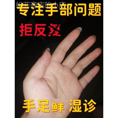 鹅掌风脱药膏手脱癣皮干裂皮真BOB菌感染手藓汗疱疹药膏真菌膏感