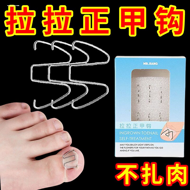 正甲丝甲沟嵌甲矫正器牵引钢丝正甲贴片脚趾指甲扎肉专用