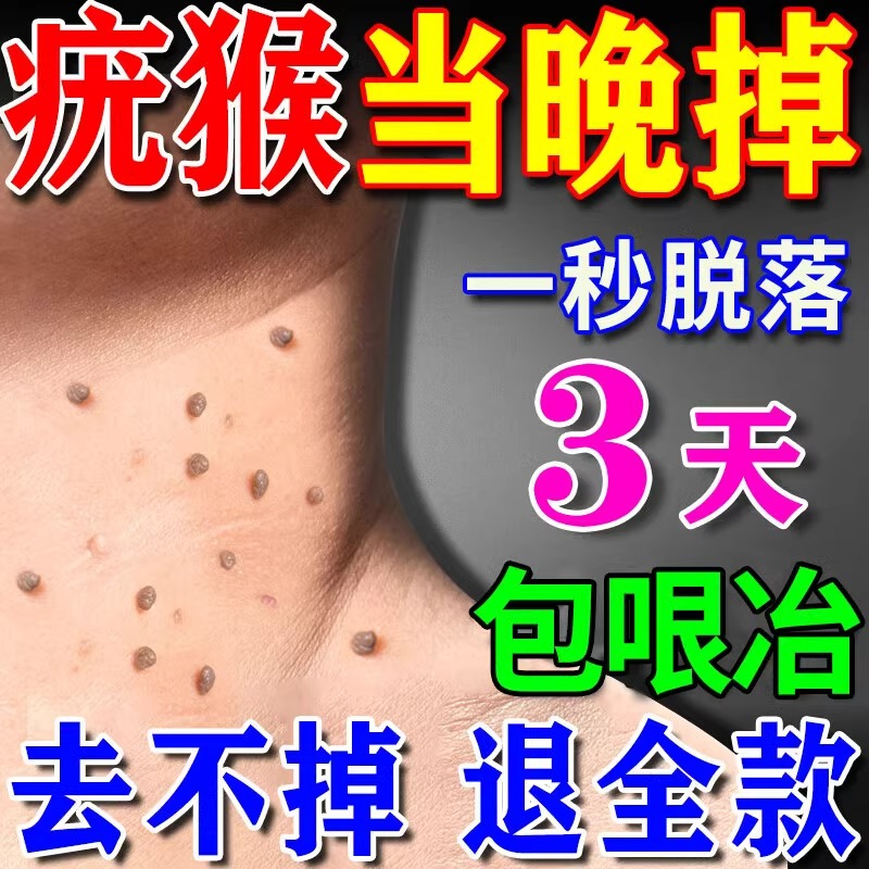 【疣瘊自然掉】去疣瘊肉粒专用膏