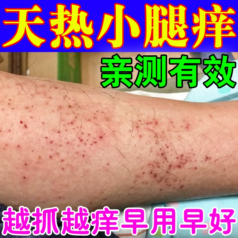 夏天小腿痒湿成人止痒膏出汗身上痒天热皮肤痒热疙瘩红疹热毒