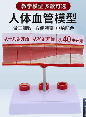 人体血管解剖模型血管q模型硬化动脉展示各阶段年龄层血管演示