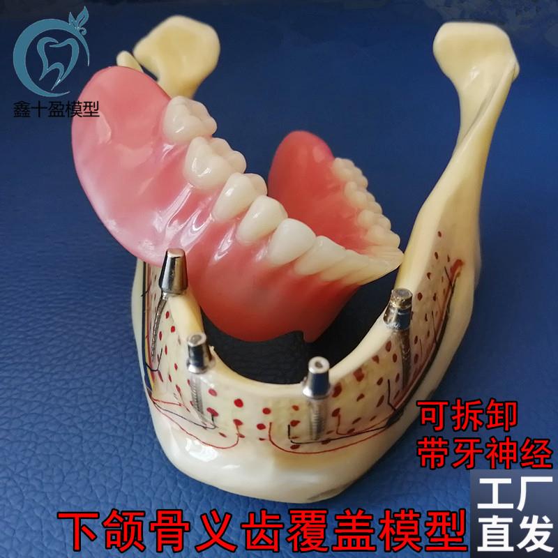 牙科口腔下颌骨h展示模型透明下颌骨展示种植钉义齿修复模型6005