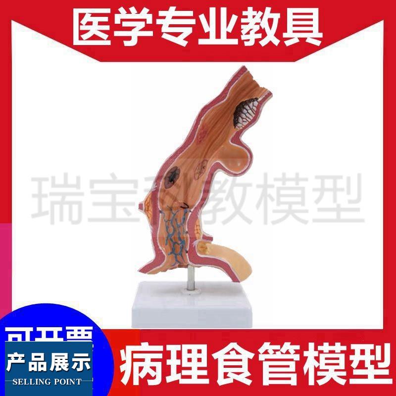食管模型消化系统胃结构病理黏膜胃壁血管神经胃镜教学医患沟通用