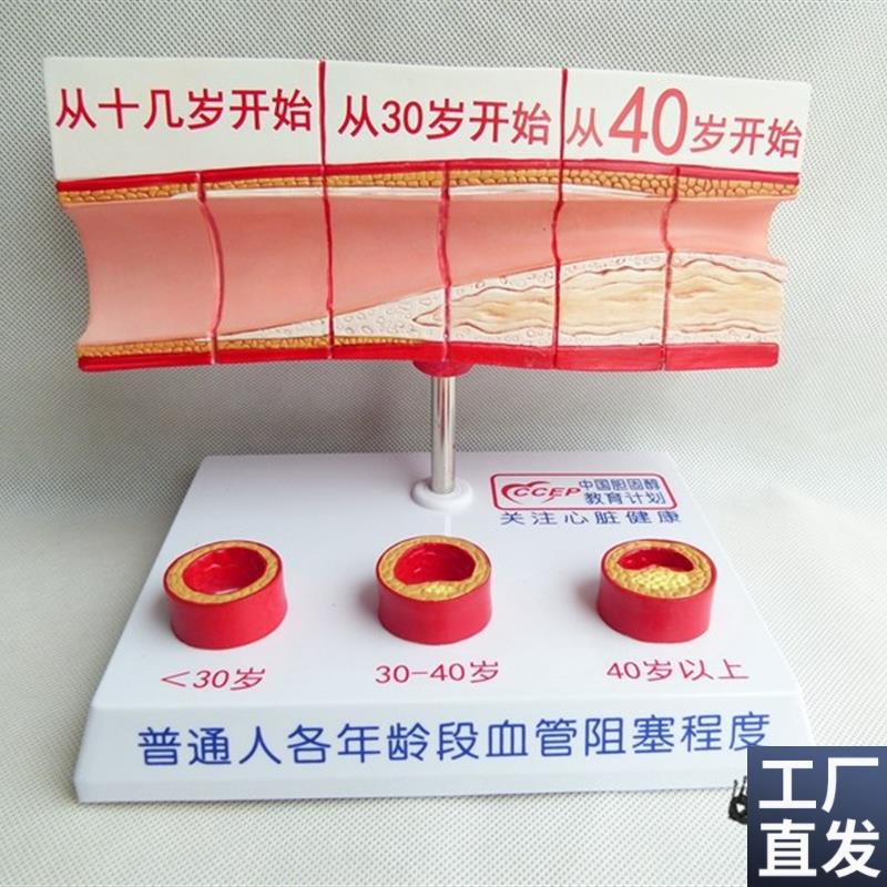 人体支脉粥样硬化n和血栓形成模型人体模型病态血管模型