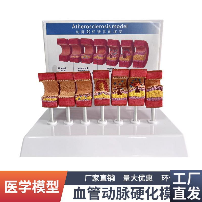 7节动脉粥样硬化模型血管u血栓栓塞演示模型人体血管模型医用教具