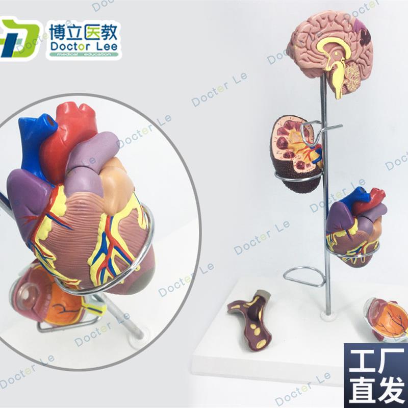 人体高血压模型高血压大脑y心脏血管内科普外科医生礼品大脑