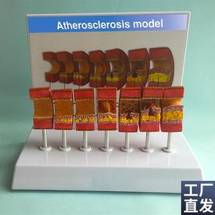 动脉粥样硬化模型血管血r栓栓塞模型动脉血管人体医用医学教学教