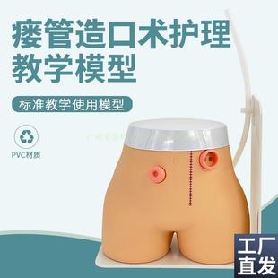 造口模型高级瘘管造口术护理模型结肠回肠造瘘教学Y模型造口冲