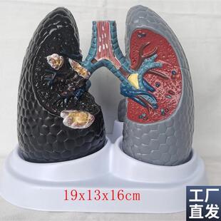 人体吸烟癌变肺k模型健康肺模型人类内脏吸烟肺与健康肺模型
