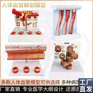 血管堵塞动支脉粥样硬化心血管动脉硬化模型N血管病理动态血栓模