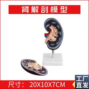肾解剖模型2件右肾作额状切面示F肾门肾血管输尿管肾盂肾脏