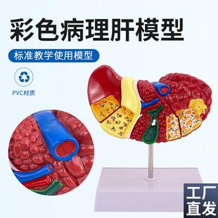 彩色肝脏模型常见临床病理特征医生用医患沟N通硬化脂肪炎肝胆内