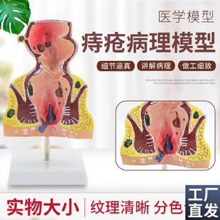 大号人体直肠模型结肠病理直肠痔C疮直肠常见病模型直肠和肛管模