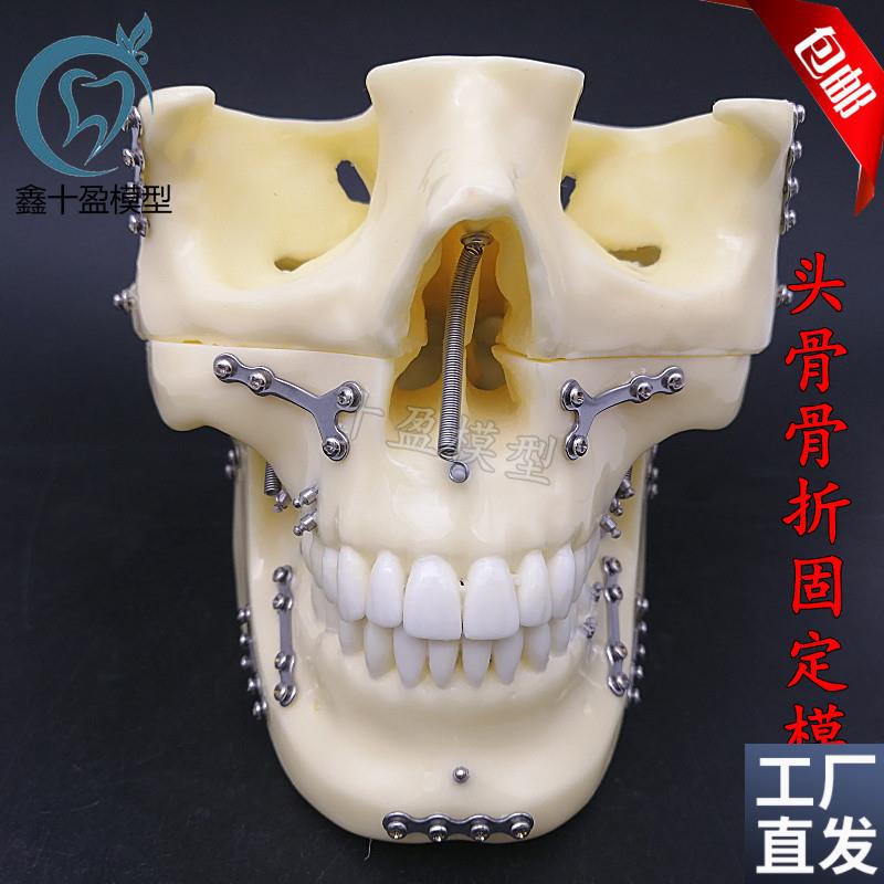 牙科种植支抗钉模型头颅骨折固定模型头颅骨口腔X模型医学教学