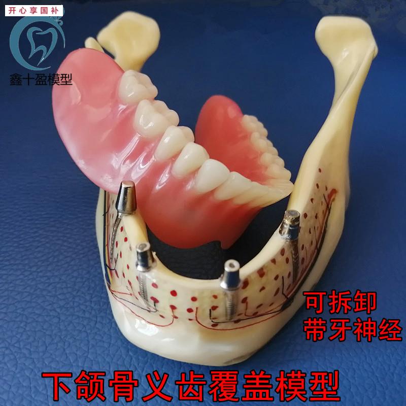 牙科口腔下颌骨展示模型透l明下颌骨展示种植钉义齿修复模型6005