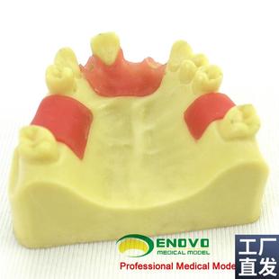 ENOVaO颐诺上颌缺失种植实训模型口腔即刻种植操作上颌骨缺失牙齿