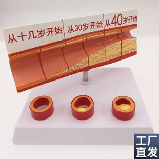 动脉血管模型不同年龄段血管内膜变化粥样M硬化栓子血管狭窄斑块