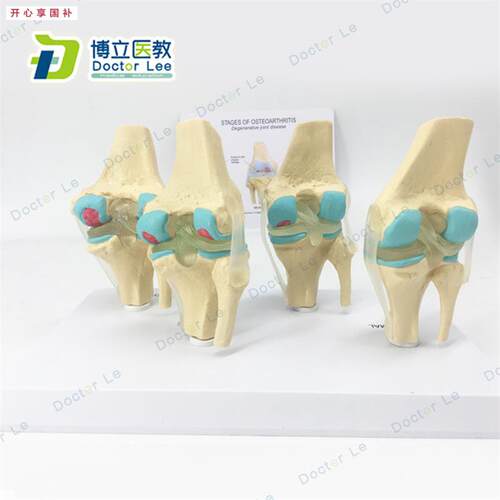 病态度膝关节模型四R阶段病理膝关节模型病变膝关节模型膝关节