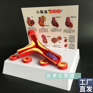 动脉模型硬化带i血栓模型动脉血管粥样硬化带血栓病变器官内脏模