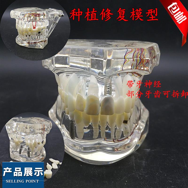 牙科材料 连桥修复体模型 病理牙模型 可拆卸活动牙种植体 包邮