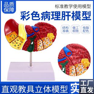 彩色肝脏模型常见临床病理特征y医生用医患沟通硬化脂肪炎肝胆内