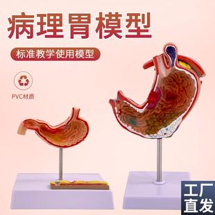 人体胃解剖模型胃的病变模型胃部疾病演示模S型病理胃胃的穿孔